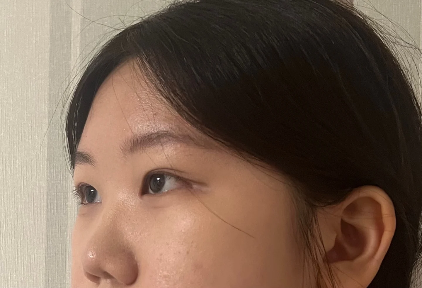 Inner canthoplasty and Wonder canthoplasty: recovery through three months · Case 049 at Answer Plastic Surgery. Angled view facing left, 1 month after inner canthoplasty and Wonder canthoplasty at Answer Plastic Surgery.