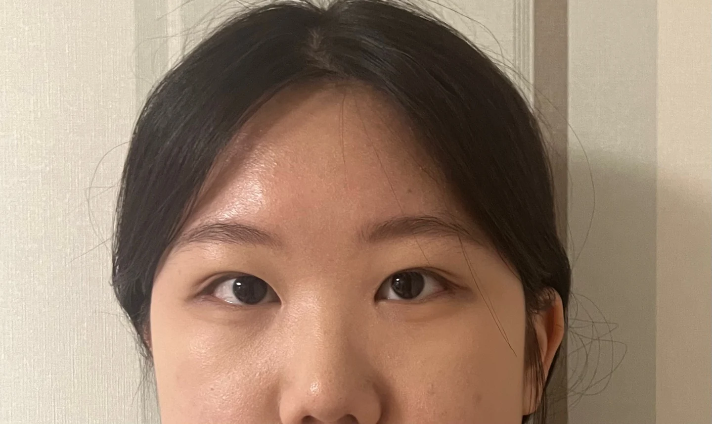 Inner canthoplasty and Wonder canthoplasty: recovery through three months · Case 049 at Answer Plastic Surgery. Front view of the eyes, 1 month after inner canthoplasty and Wonder canthoplasty at Answer Plastic Surgery.