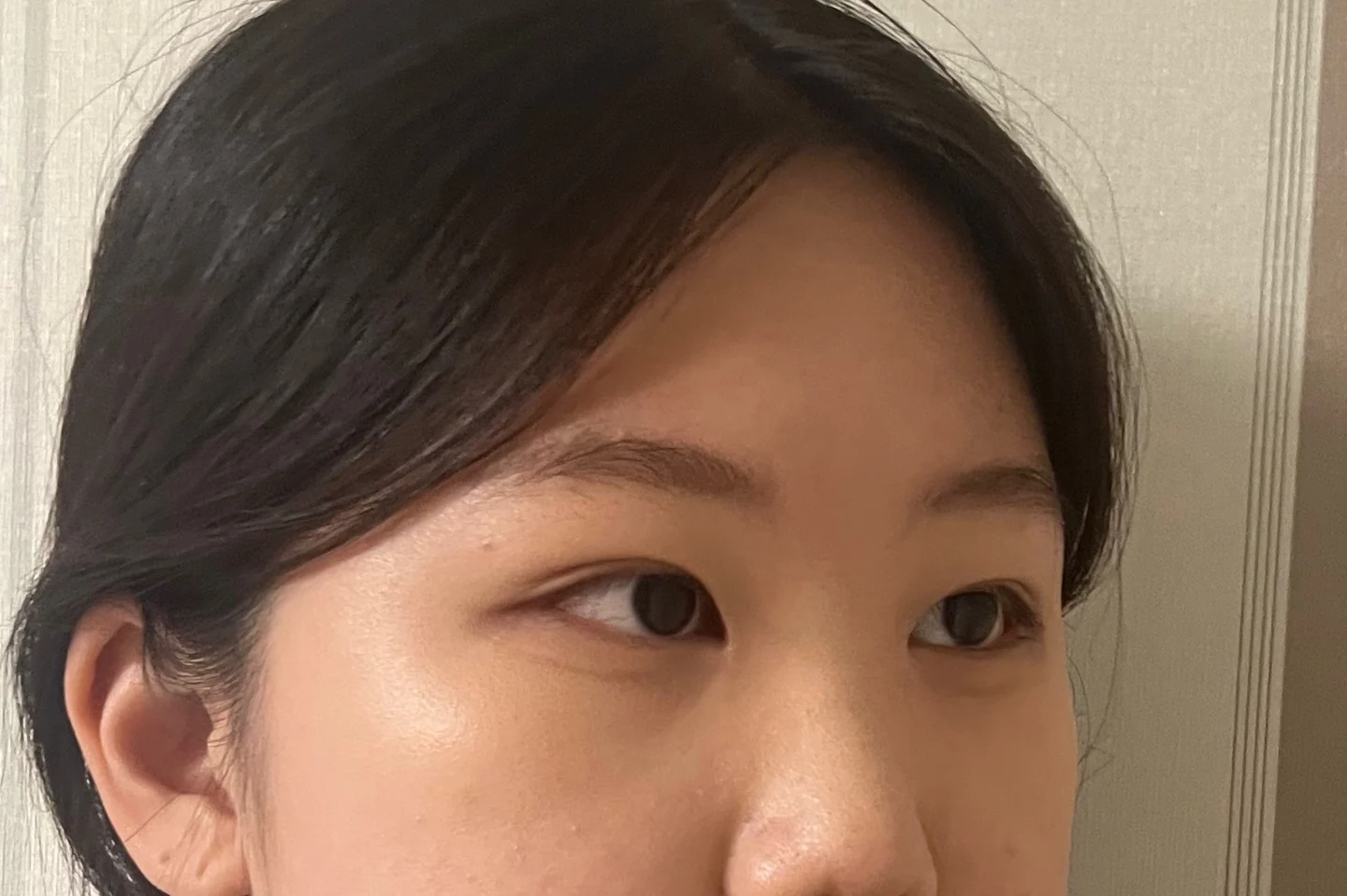 Inner canthoplasty and Wonder canthoplasty: recovery through three months · Case 049 at Answer Plastic Surgery. Angled view facing right, 1 month after inner canthoplasty and Wonder canthoplasty at Answer Plastic Surgery.