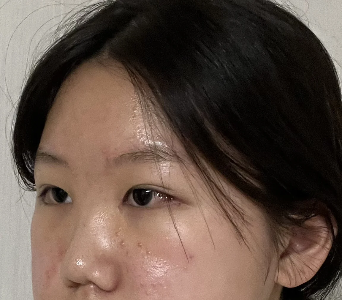 Inner canthoplasty and Wonder canthoplasty: recovery through three months · Case 049 at Answer Plastic Surgery. Angled view facing left, 1 week after inner canthoplasty and Wonder canthoplasty at Answer Plastic Surgery.