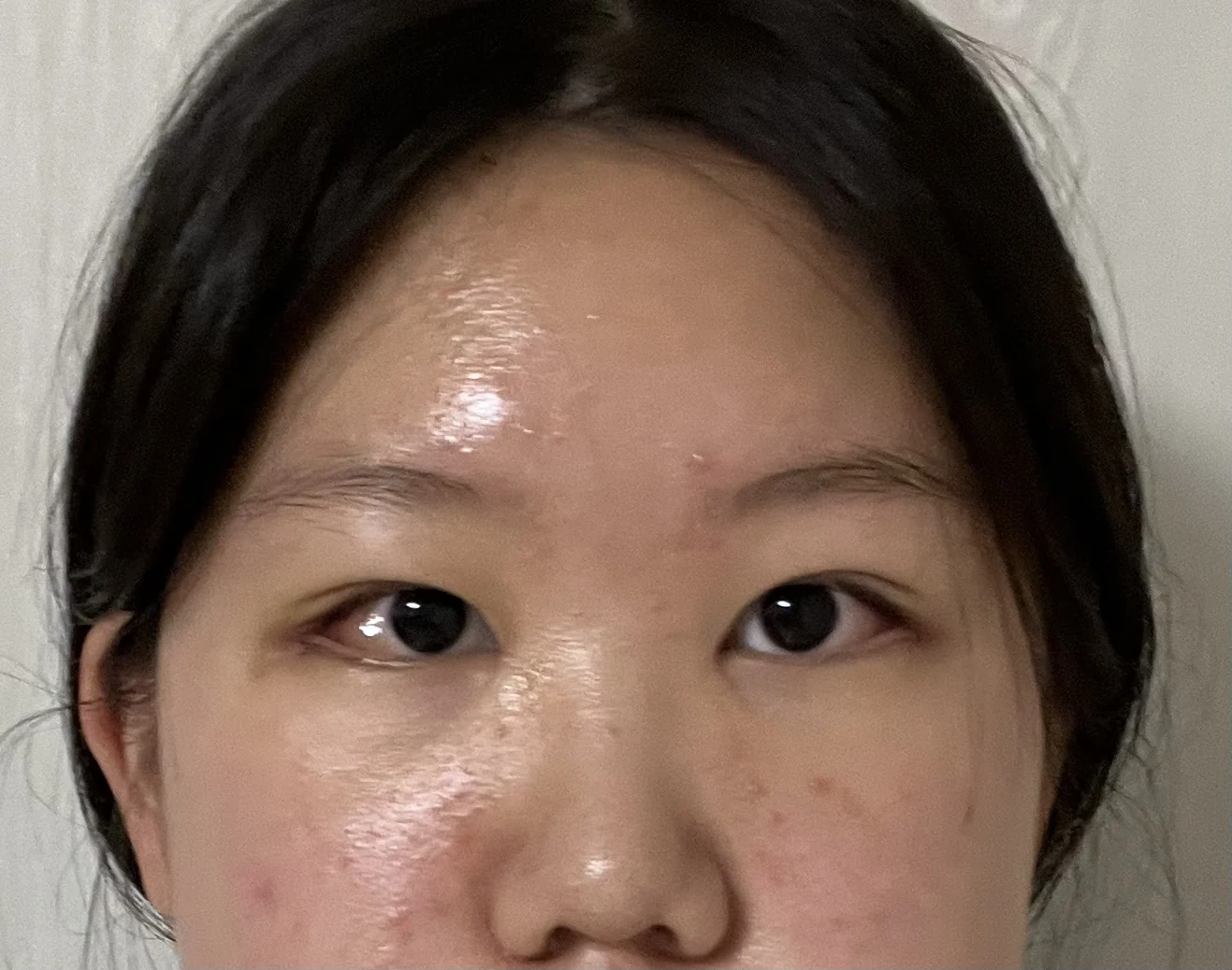 Inner canthoplasty and Wonder canthoplasty: recovery through three months · Case 049 at Answer Plastic Surgery. Front view of the eyes, 1 week after inner canthoplasty and Wonder canthoplasty at Answer Plastic Surgery.