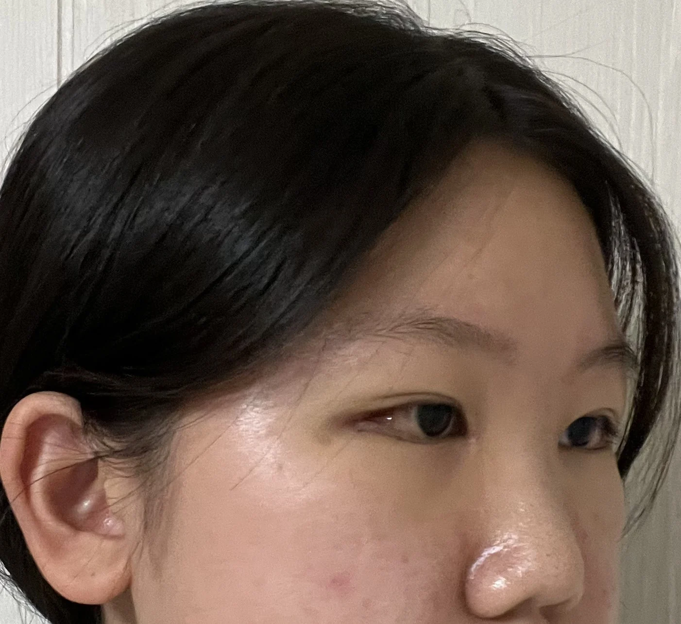 Inner canthoplasty and Wonder canthoplasty: recovery through three months · Case 049 at Answer Plastic Surgery. Angled view facing right, 1 week after inner canthoplasty and Wonder canthoplasty at Answer Plastic Surgery.