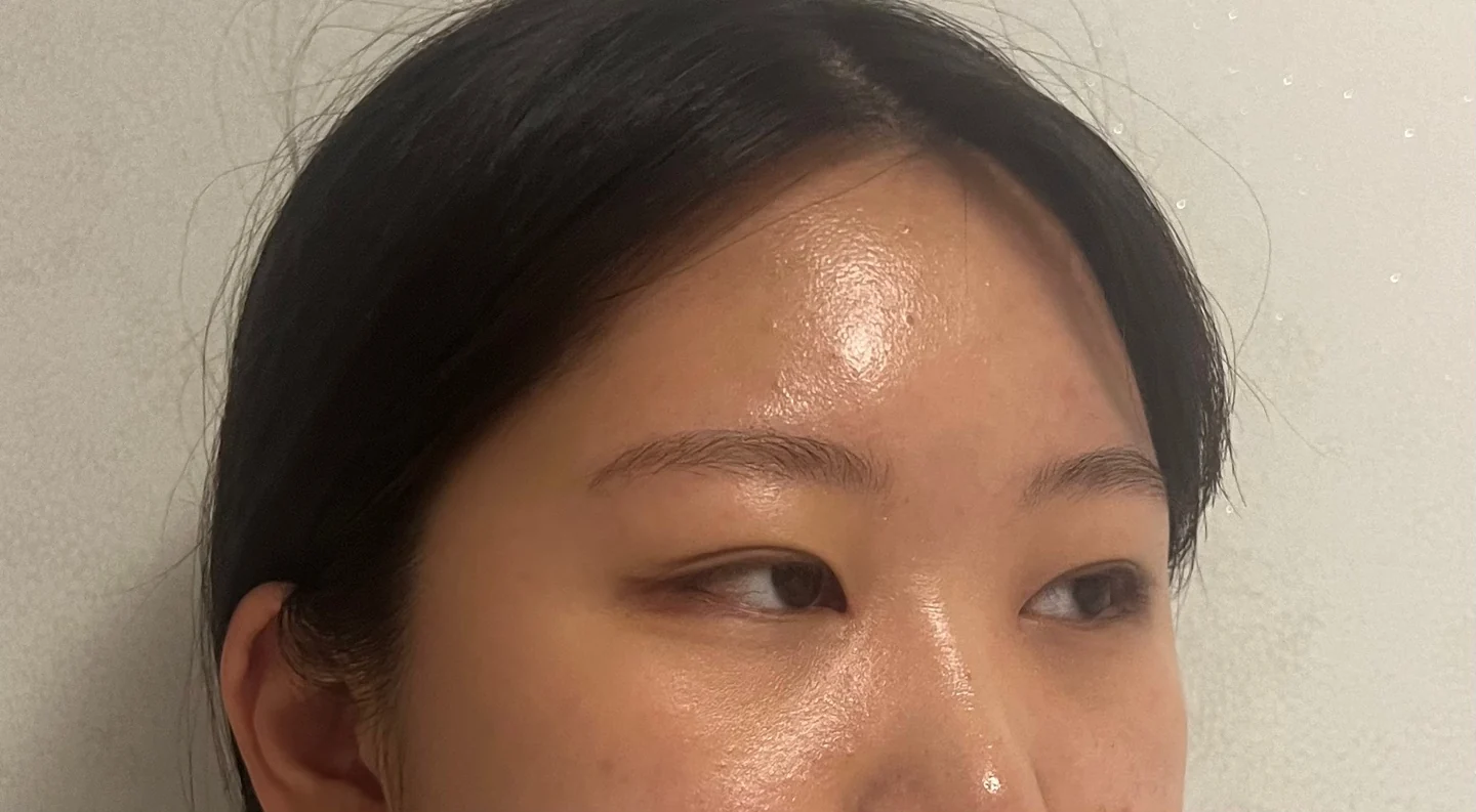 Inner canthoplasty and Wonder canthoplasty: recovery through three months · Case 049 at Answer Plastic Surgery. Angled view facing right, 2 months after inner canthoplasty and Wonder canthoplasty at Answer Plastic Surgery.