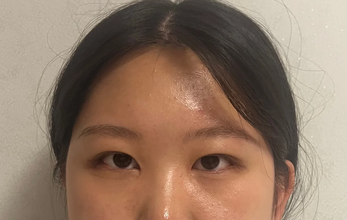 Inner canthoplasty and Wonder canthoplasty: recovery through three months · Case 049 at Answer Plastic Surgery. Front view of the eyes, 2 months after inner canthoplasty and Wonder canthoplasty at Answer Plastic Surgery.