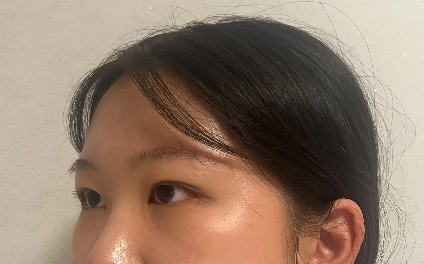 Inner canthoplasty and Wonder canthoplasty: recovery through three months · Case 049 at Answer Plastic Surgery. Angled view facing left, 2 months after inner canthoplasty and Wonder canthoplasty at Answer Plastic Surgery.