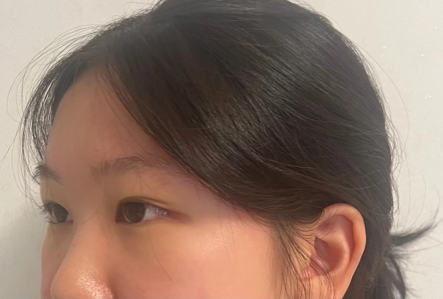 Inner canthoplasty and Wonder canthoplasty: recovery through three months · Case 049 at Answer Plastic Surgery. Angled view facing left, 3 months after inner canthoplasty and Wonder canthoplasty at Answer Plastic Surgery.