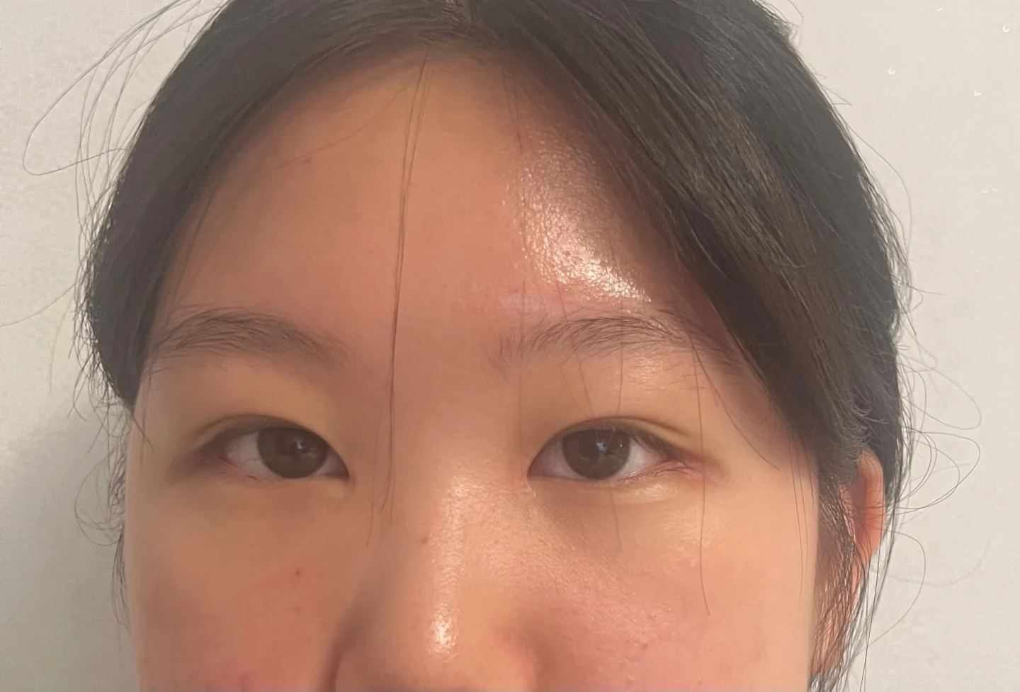 Inner canthoplasty and Wonder canthoplasty: recovery through three months · Case 049 at Answer Plastic Surgery. Front view of the eyes, 3 months after inner canthoplasty and Wonder canthoplasty at Answer Plastic Surgery.