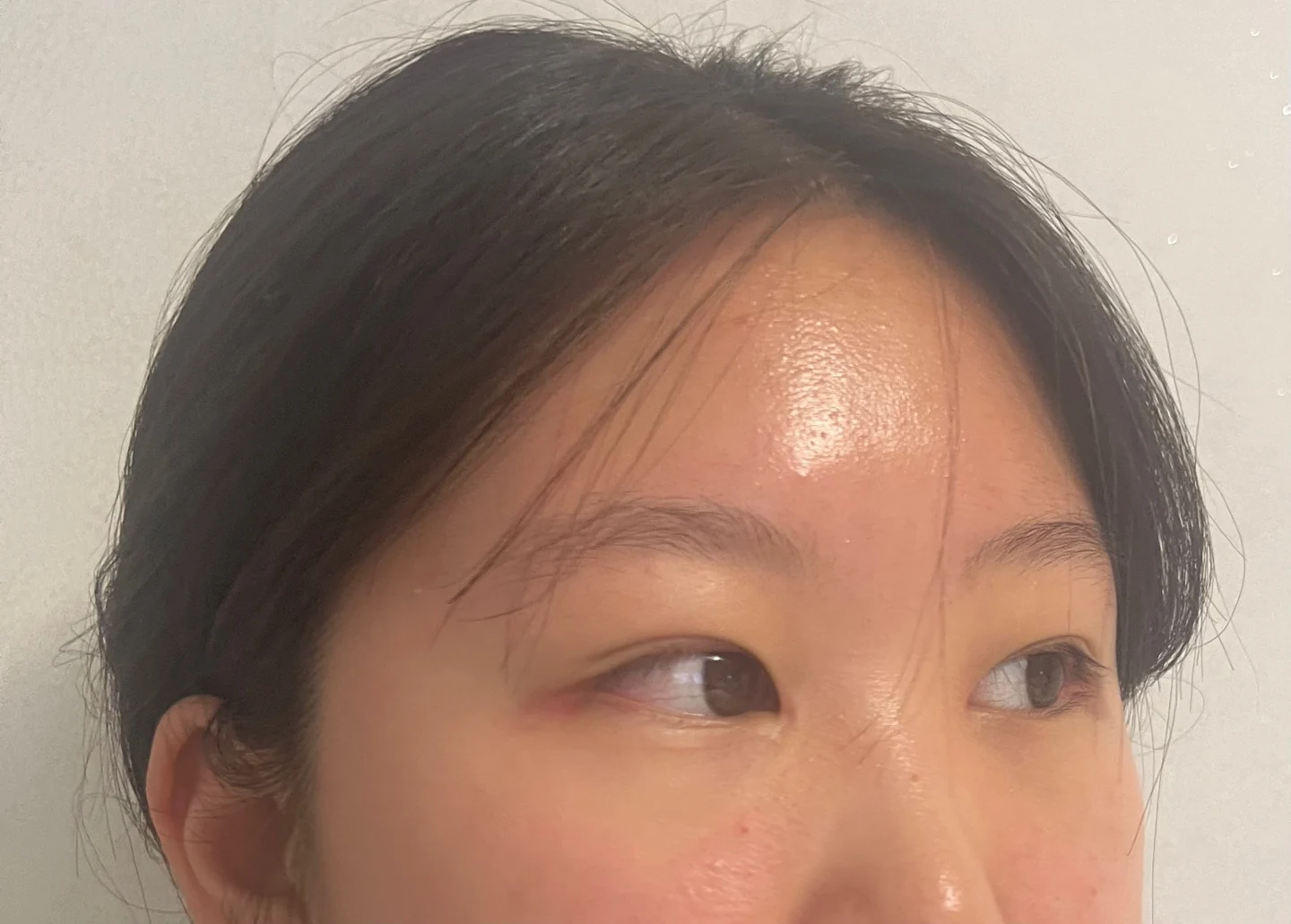 Inner canthoplasty and Wonder canthoplasty: recovery through three months · Case 049 at Answer Plastic Surgery. Angled view facing right, 3 months after inner canthoplasty and Wonder canthoplasty at Answer Plastic Surgery.