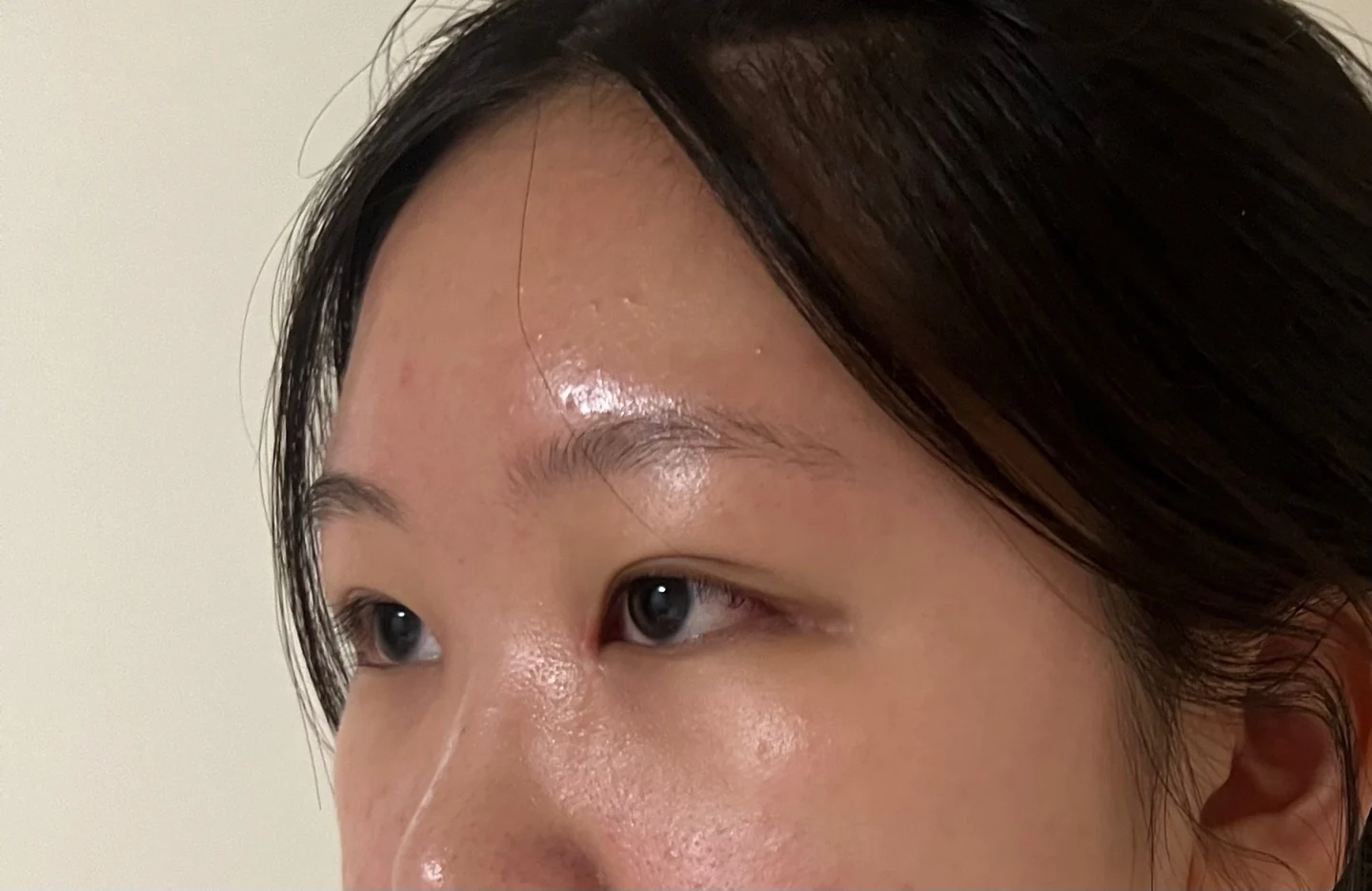 Inner canthoplasty and Wonder canthoplasty: recovery through three months · Case 049 at Answer Plastic Surgery. Angled view facing left, 3 weeks after inner canthoplasty and Wonder canthoplasty at Answer Plastic Surgery.