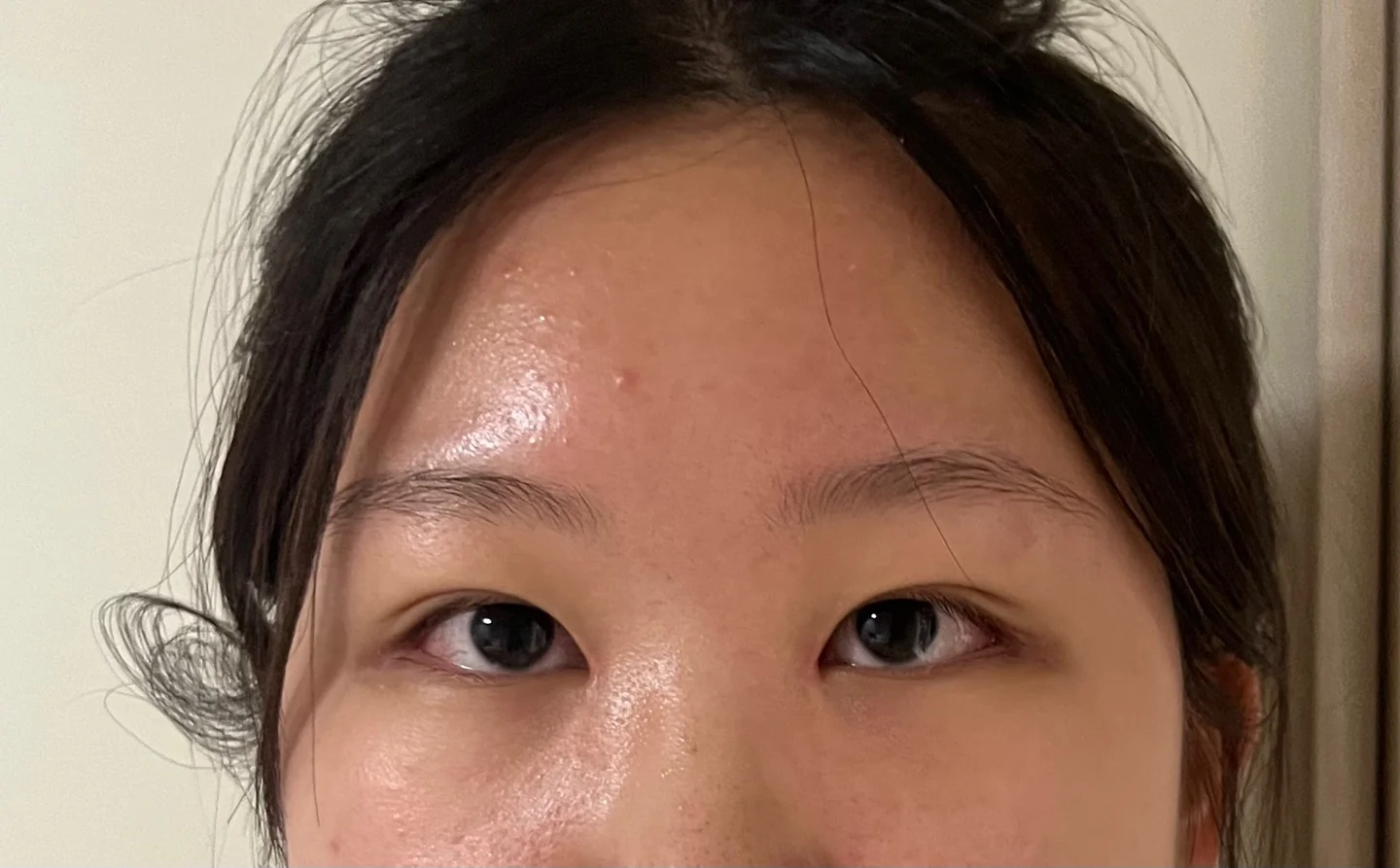 Inner canthoplasty and Wonder canthoplasty: recovery through three months · Case 049 at Answer Plastic Surgery. Front view of the eyes, 3 weeks after inner canthoplasty and Wonder canthoplasty at Answer Plastic Surgery.