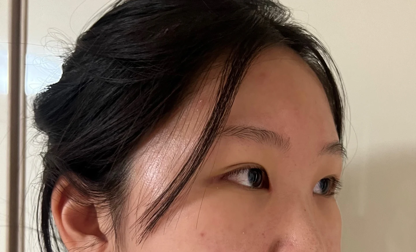 Inner canthoplasty and Wonder canthoplasty: recovery through three months · Case 049 at Answer Plastic Surgery. Angled view facing right, 3 weeks after inner canthoplasty and Wonder canthoplasty at Answer Plastic Surgery.