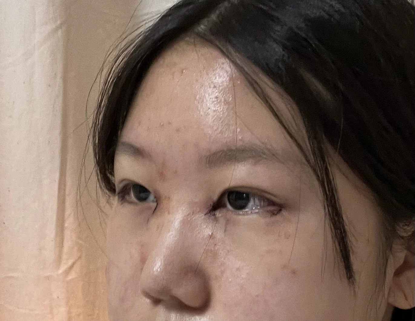 Inner canthoplasty and Wonder canthoplasty: recovery through three months · Case 049 at Answer Plastic Surgery. Angled view facing left, surgery day after inner canthoplasty and Wonder canthoplasty at Answer Plastic Surgery.