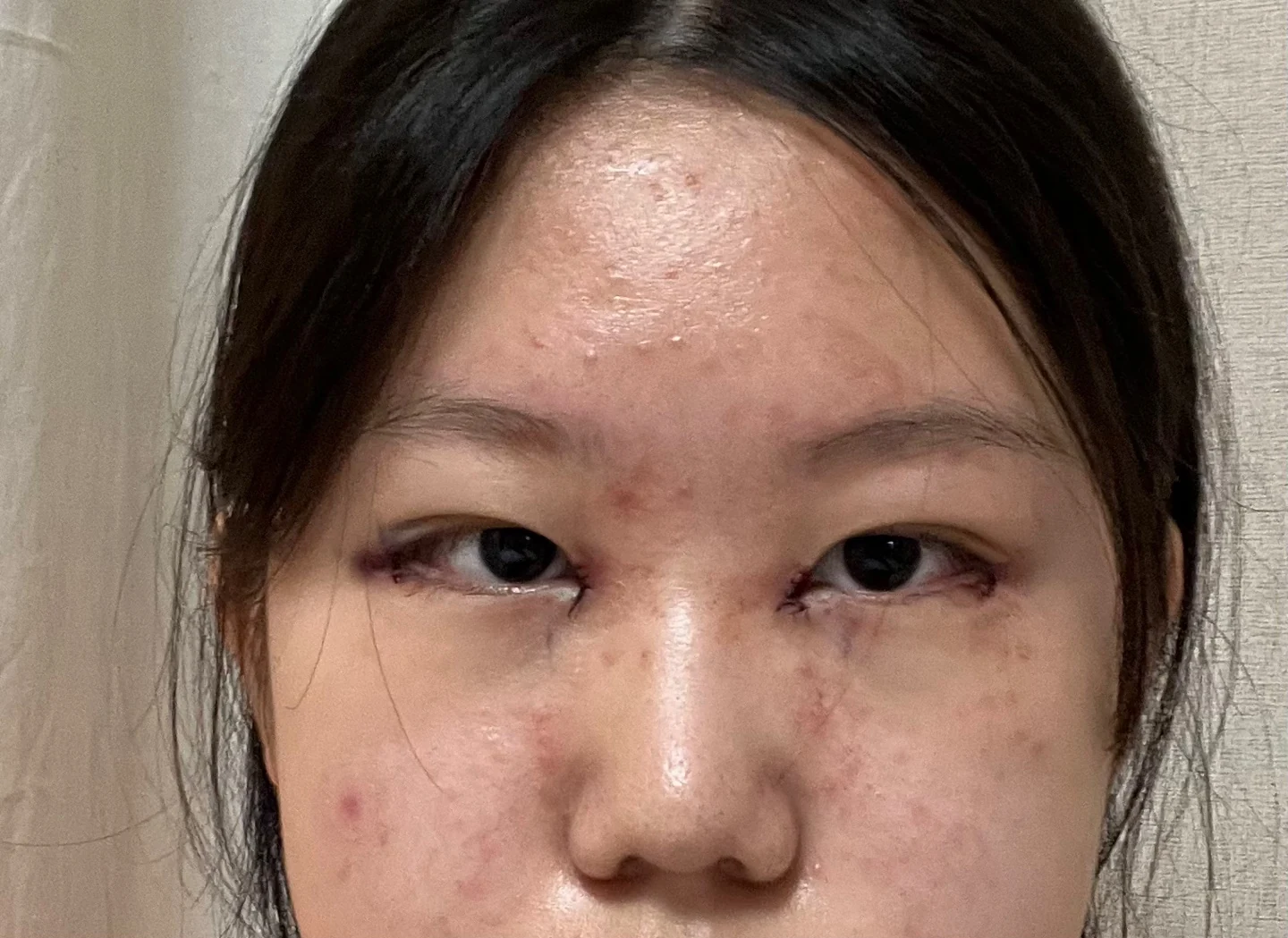 Inner canthoplasty and Wonder canthoplasty: recovery through three months · Case 049 at Answer Plastic Surgery. Front view of the eyes, surgery day after inner canthoplasty and Wonder canthoplasty at Answer Plastic Surgery.