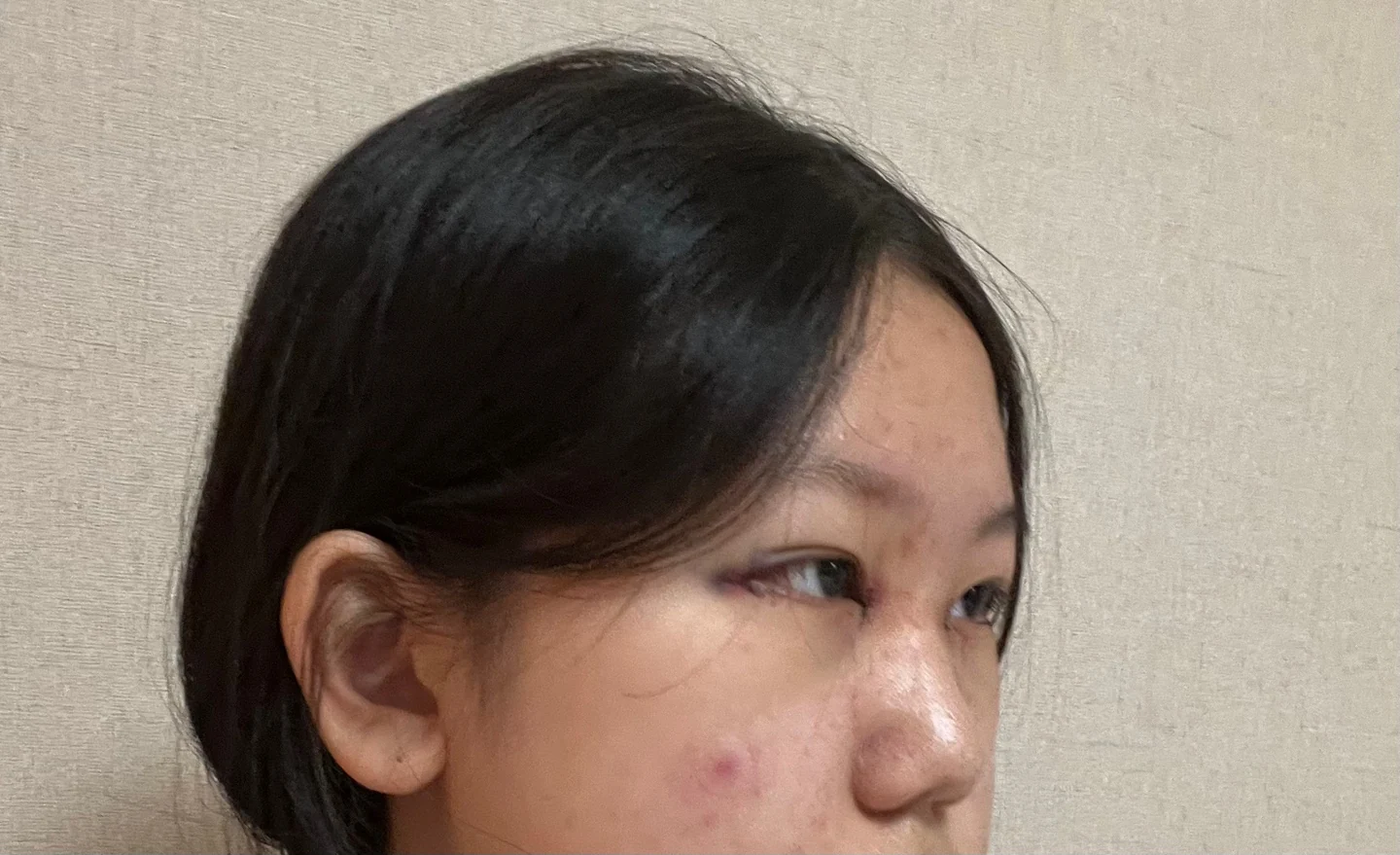 Inner canthoplasty and Wonder canthoplasty: recovery through three months · Case 049 at Answer Plastic Surgery. Angled view facing right, surgery day after inner canthoplasty and Wonder canthoplasty at Answer Plastic Surgery.