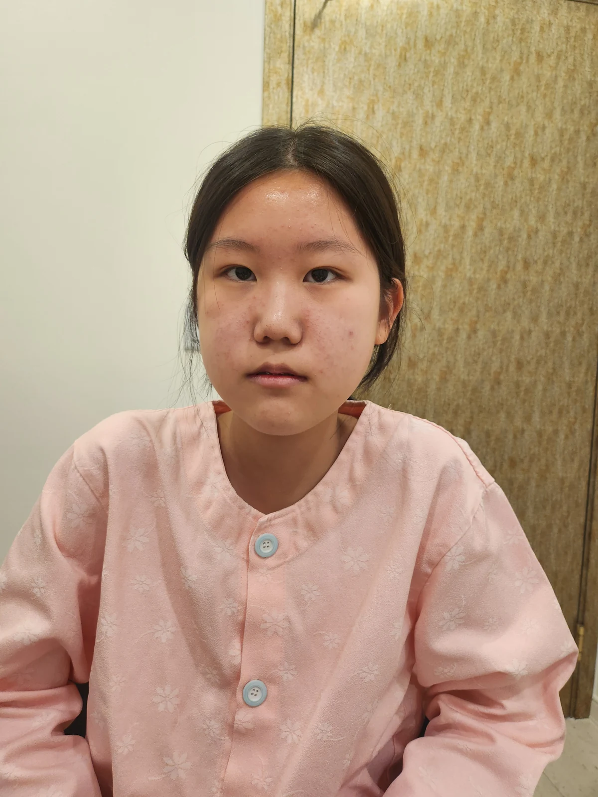 Inner canthoplasty and Wonder canthoplasty: recovery through three months · Case 049 at Answer Plastic Surgery. Front view before inner canthoplasty and Wonder canthoplasty at Answer Plastic Surgery.