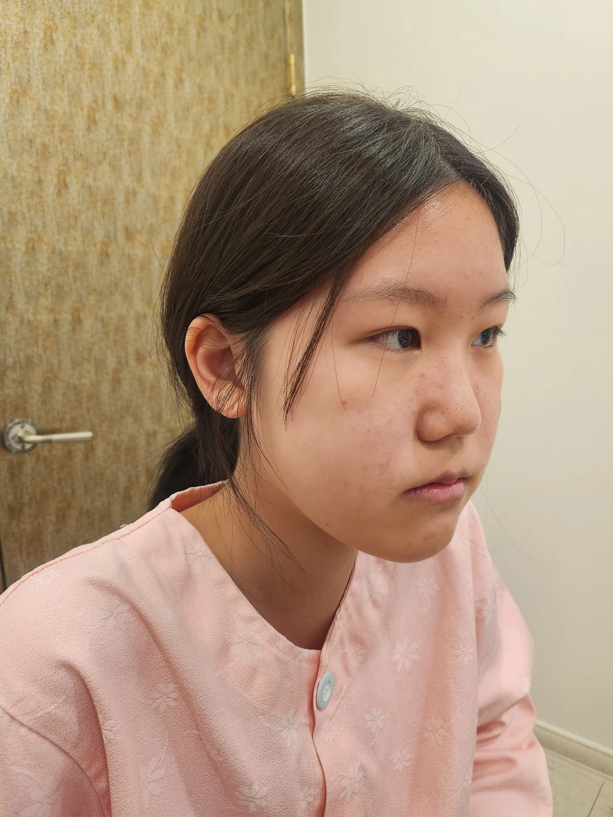 Inner canthoplasty and Wonder canthoplasty: recovery through three months · Case 049 at Answer Plastic Surgery. Angled view facing right before inner canthoplasty and Wonder canthoplasty at Answer Plastic Surgery.