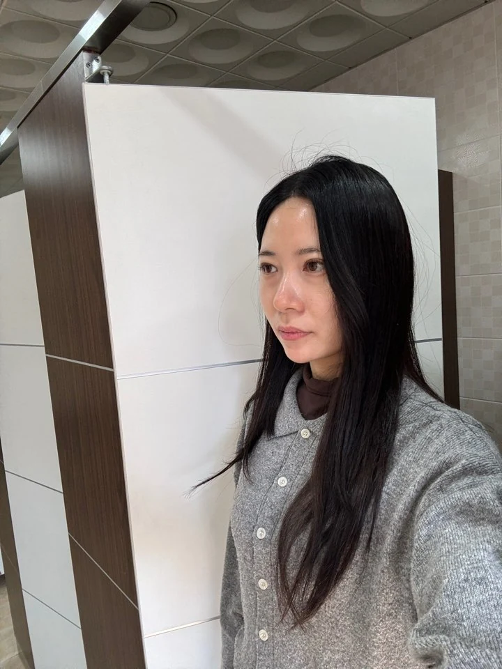 Incisional double-eyelid surgery and lateral canthoplasty: two weeks and one month · Case 050 at Answer Plastic Surgery. Angled view facing left, 1 month after incisional double-eyelid surgery and lateral canthoplasty at Answer Plastic Surgery.