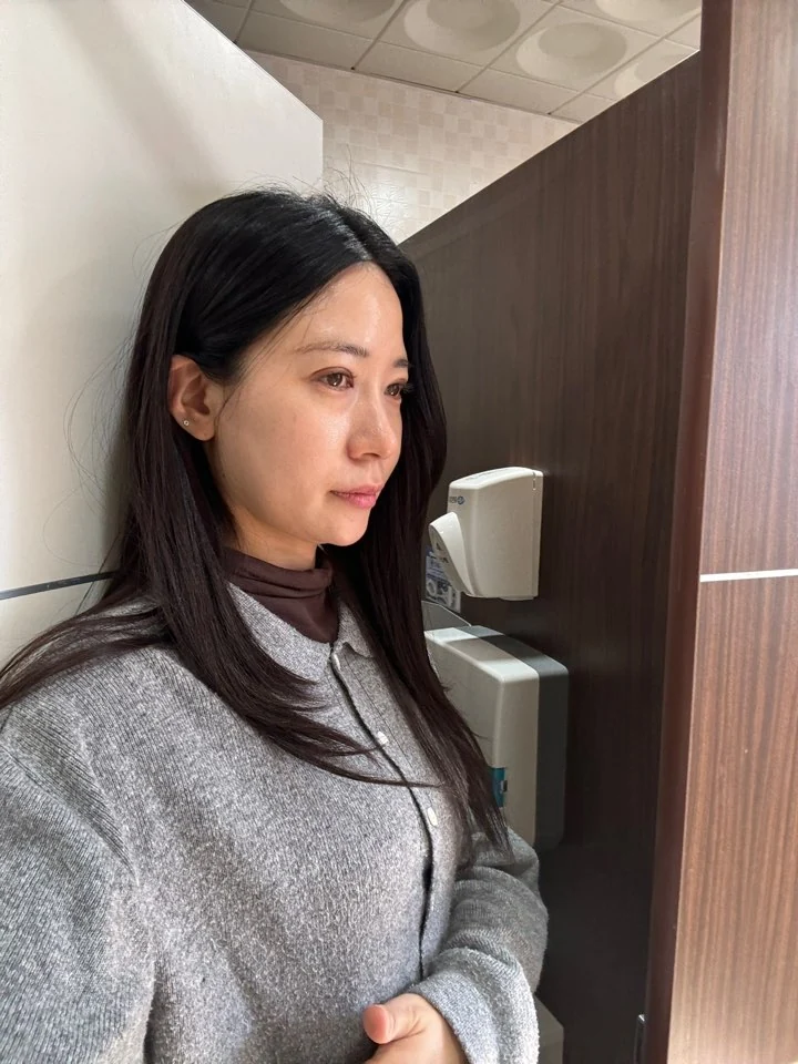 Incisional double-eyelid surgery and lateral canthoplasty: two weeks and one month · Case 050 at Answer Plastic Surgery. Angled view facing right, 1 month after incisional double-eyelid surgery and lateral canthoplasty at Answer Plastic Surgery.