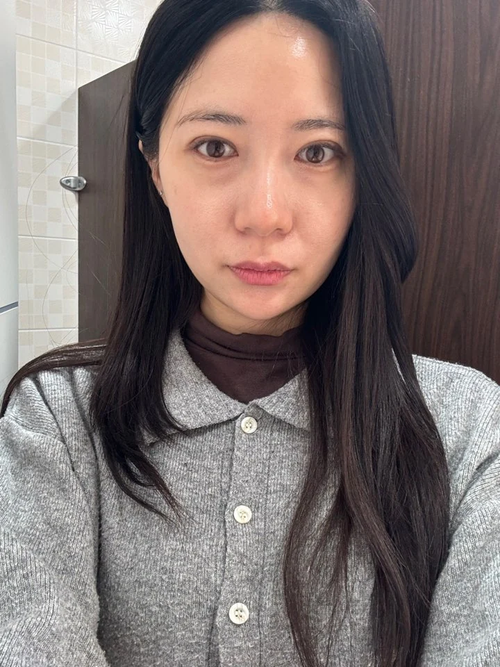 Incisional double-eyelid surgery and lateral canthoplasty: two weeks and one month · Case 050 at Answer Plastic Surgery. Front view, 1 month after incisional double-eyelid surgery and lateral canthoplasty at Answer Plastic Surgery.