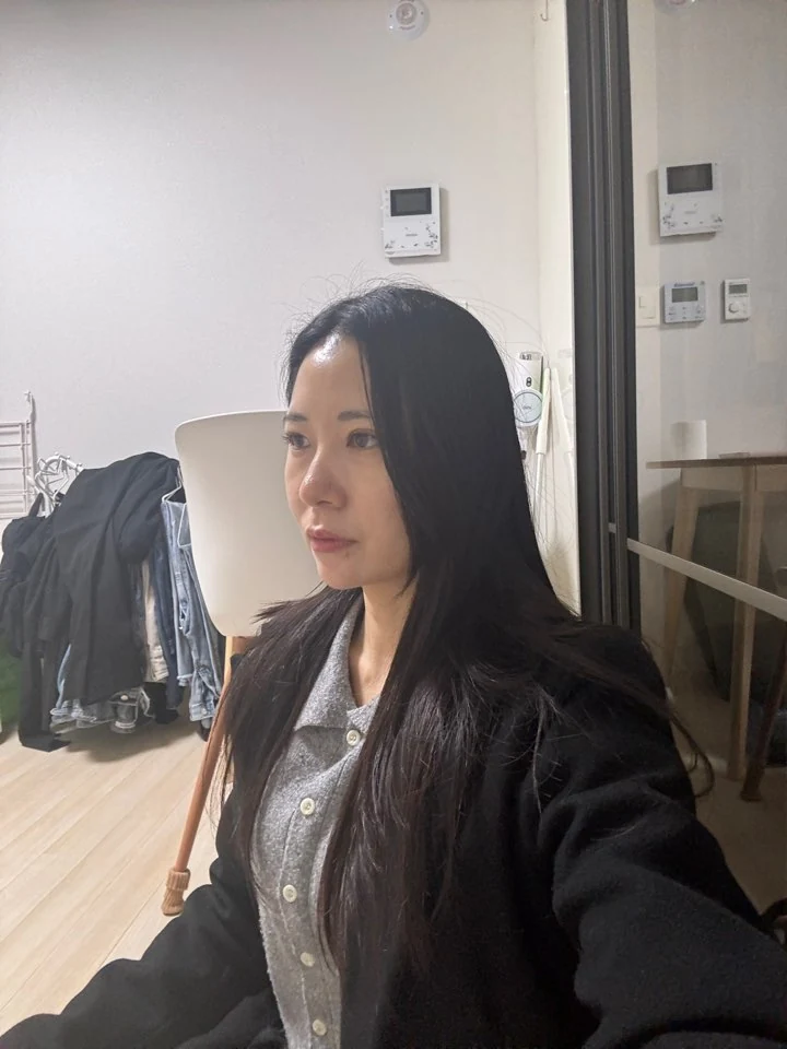 Incisional double-eyelid surgery and lateral canthoplasty: two weeks and one month · Case 050 at Answer Plastic Surgery. Angled view facing left, 2 weeks after incisional double-eyelid surgery and lateral canthoplasty at Answer Plastic Surgery.