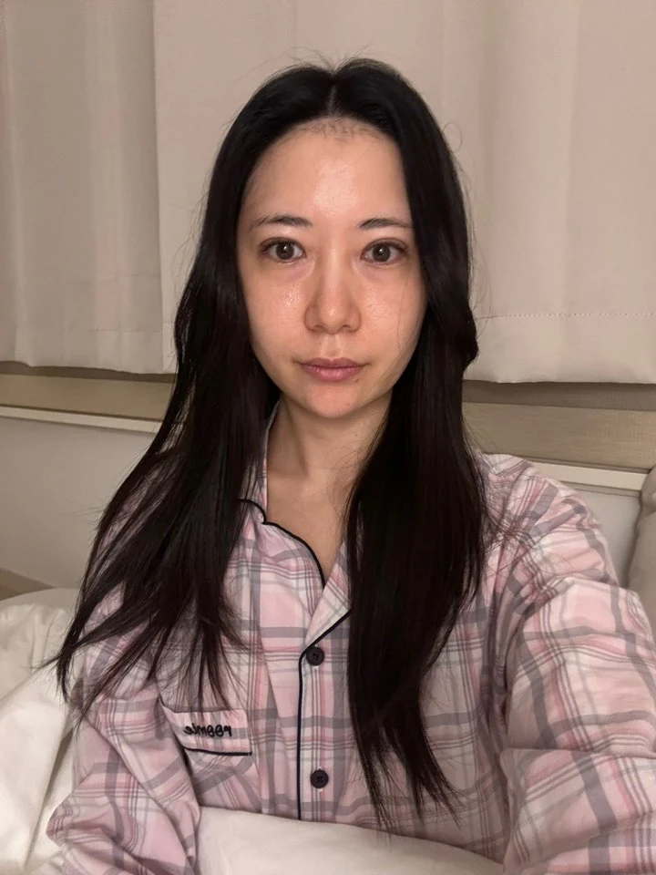 Incisional double-eyelid surgery and lateral canthoplasty: two weeks and one month · Case 050 at Answer Plastic Surgery. Front view, 2 weeks after incisional double-eyelid surgery and lateral canthoplasty at Answer Plastic Surgery.