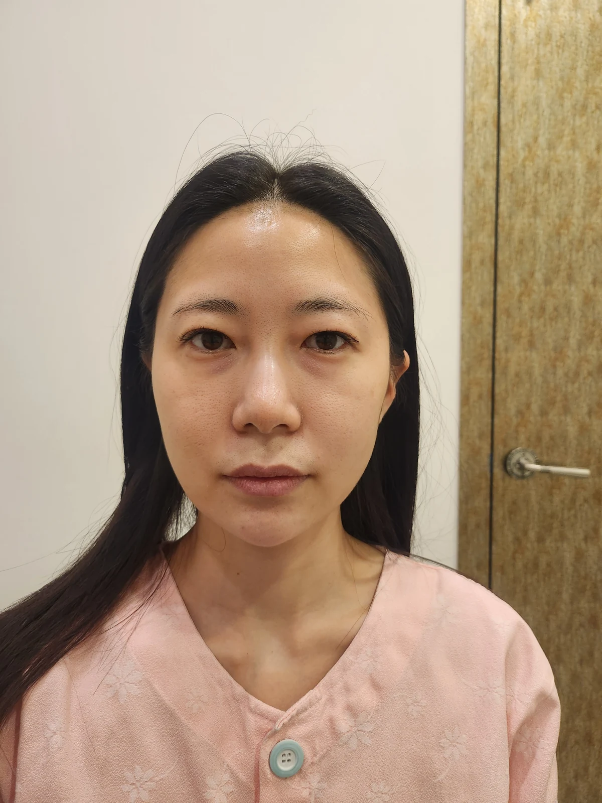 Incisional double-eyelid surgery and lateral canthoplasty: two weeks and one month · Case 050 at Answer Plastic Surgery. Front view before incisional double-eyelid surgery and lateral canthoplasty at Answer Plastic Surgery.