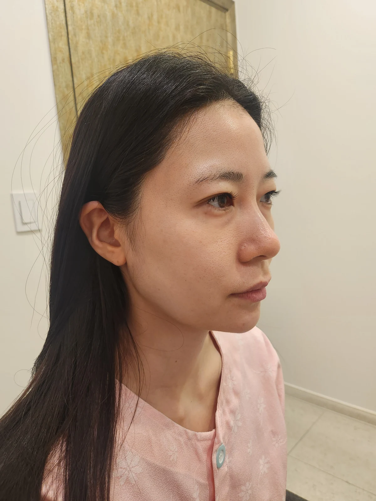 Incisional double-eyelid surgery and lateral canthoplasty: two weeks and one month · Case 050 at Answer Plastic Surgery. Angled view facing right before incisional double-eyelid surgery and lateral canthoplasty at Answer Plastic Surgery.