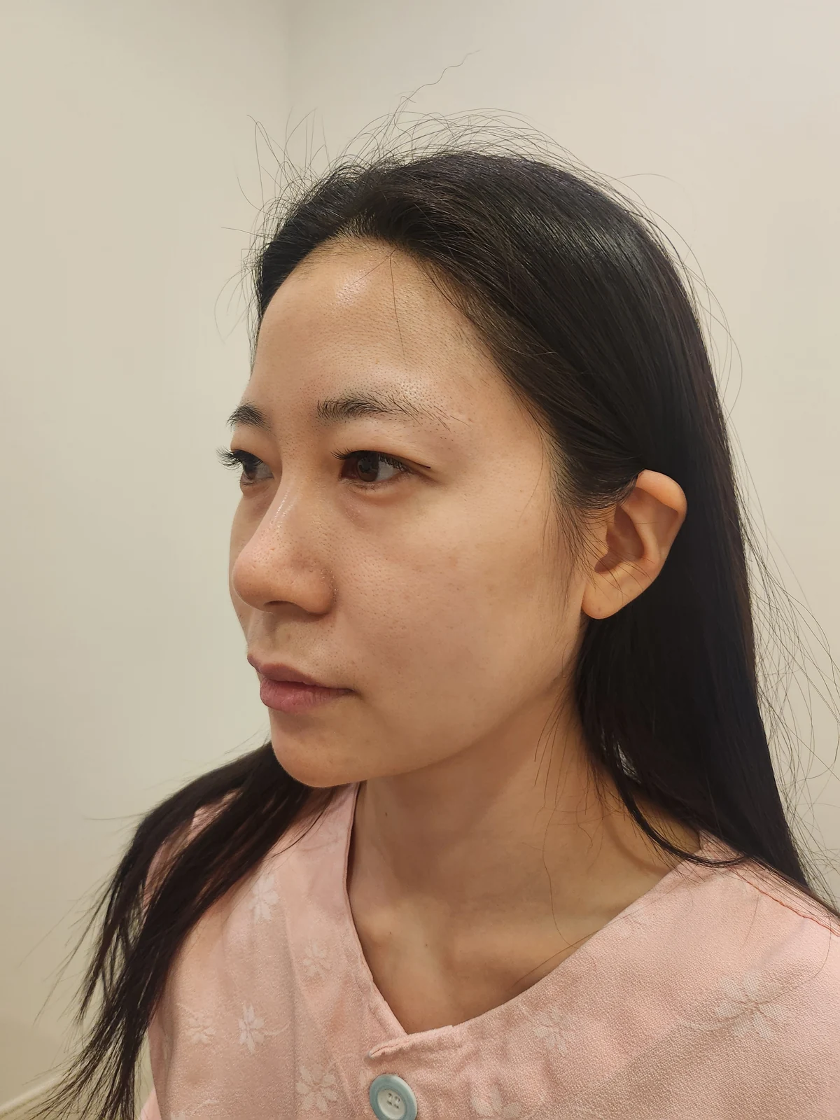Incisional double-eyelid surgery and lateral canthoplasty: two weeks and one month · Case 050 at Answer Plastic Surgery. Angled view facing left before incisional double-eyelid surgery and lateral canthoplasty at Answer Plastic Surgery.