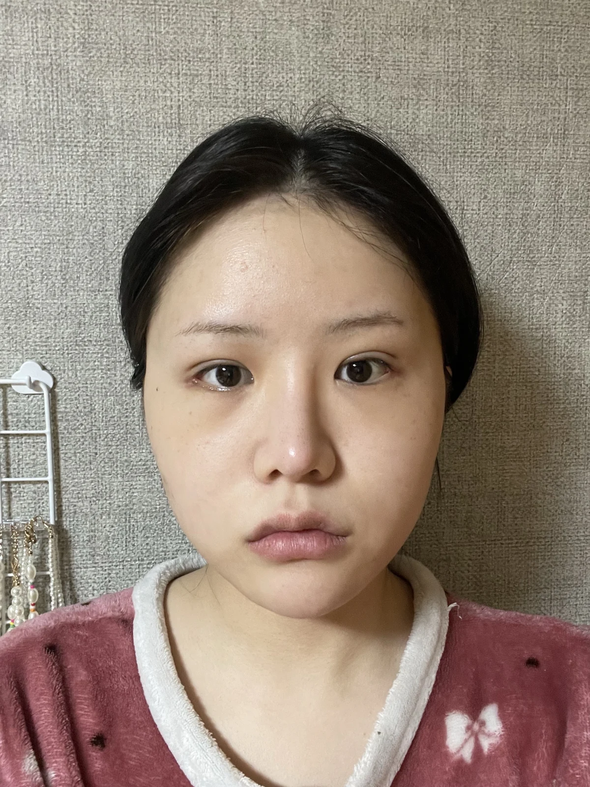 Ptosis correction and Wonder canthoplasty: recovery through two months · Case 051 at Answer Plastic Surgery. Front view, 1 month after ptosis correction and Wonder canthoplasty at Answer Plastic Surgery.