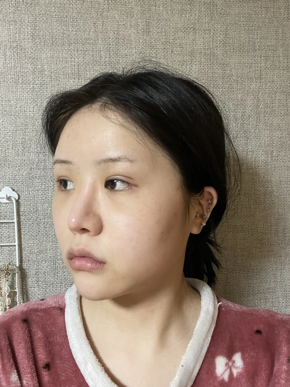 Ptosis correction and Wonder canthoplasty: recovery through two months · Case 051 at Answer Plastic Surgery. Angled view facing left, 1 month after ptosis correction and Wonder canthoplasty at Answer Plastic Surgery.