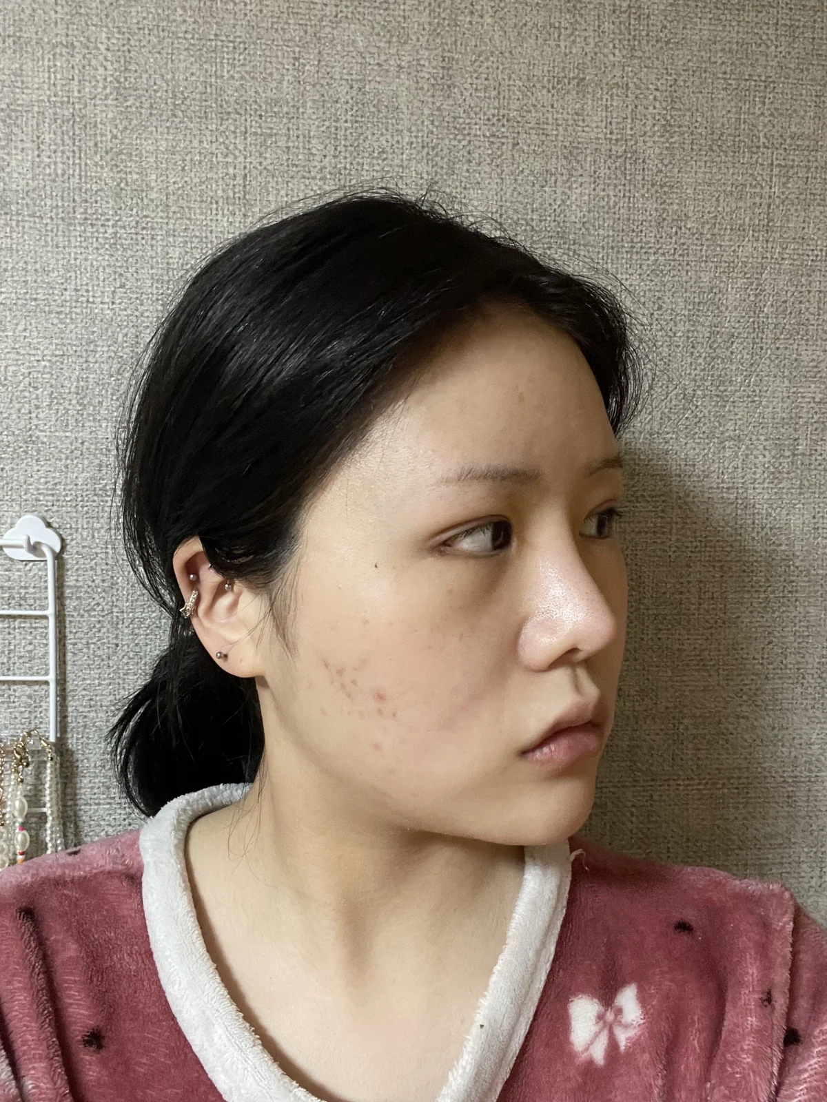 Ptosis correction and Wonder canthoplasty: recovery through two months · Case 051 at Answer Plastic Surgery. Angled view facing right, 1 month after ptosis correction and Wonder canthoplasty at Answer Plastic Surgery.