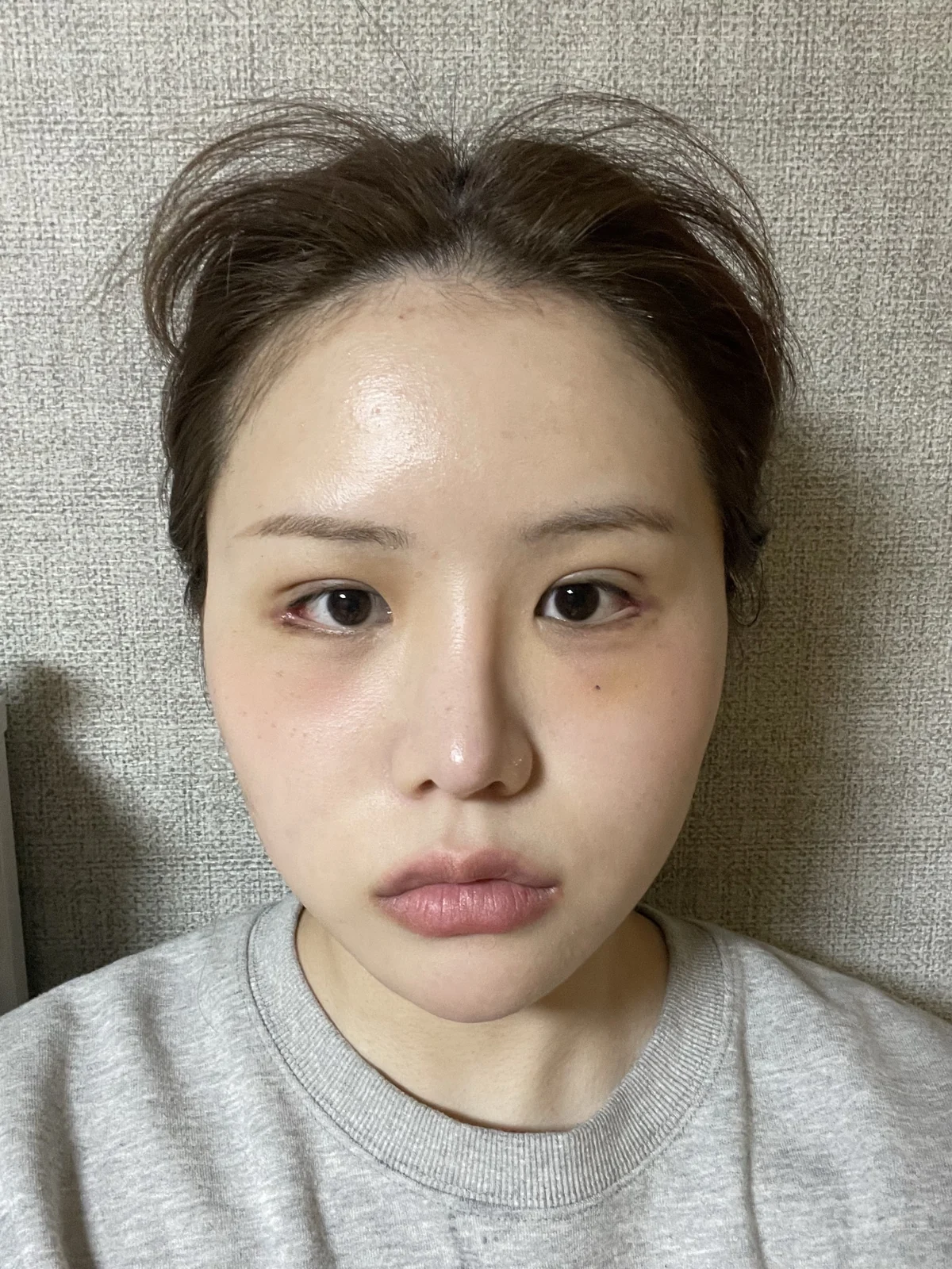 Ptosis correction and Wonder canthoplasty: recovery through two months · Case 051 at Answer Plastic Surgery. Front view, 1 week after ptosis correction and Wonder canthoplasty at Answer Plastic Surgery.
