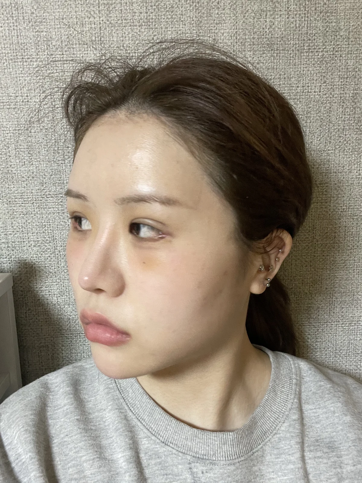 Ptosis correction and Wonder canthoplasty: recovery through two months · Case 051 at Answer Plastic Surgery. Angled view facing left, 1 week after ptosis correction and Wonder canthoplasty at Answer Plastic Surgery.