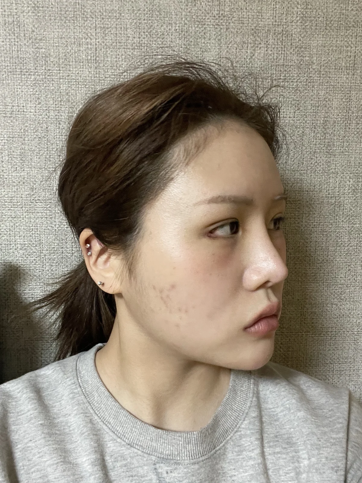 Ptosis correction and Wonder canthoplasty: recovery through two months · Case 051 at Answer Plastic Surgery. Angled view facing right, 1 week after ptosis correction and Wonder canthoplasty at Answer Plastic Surgery.
