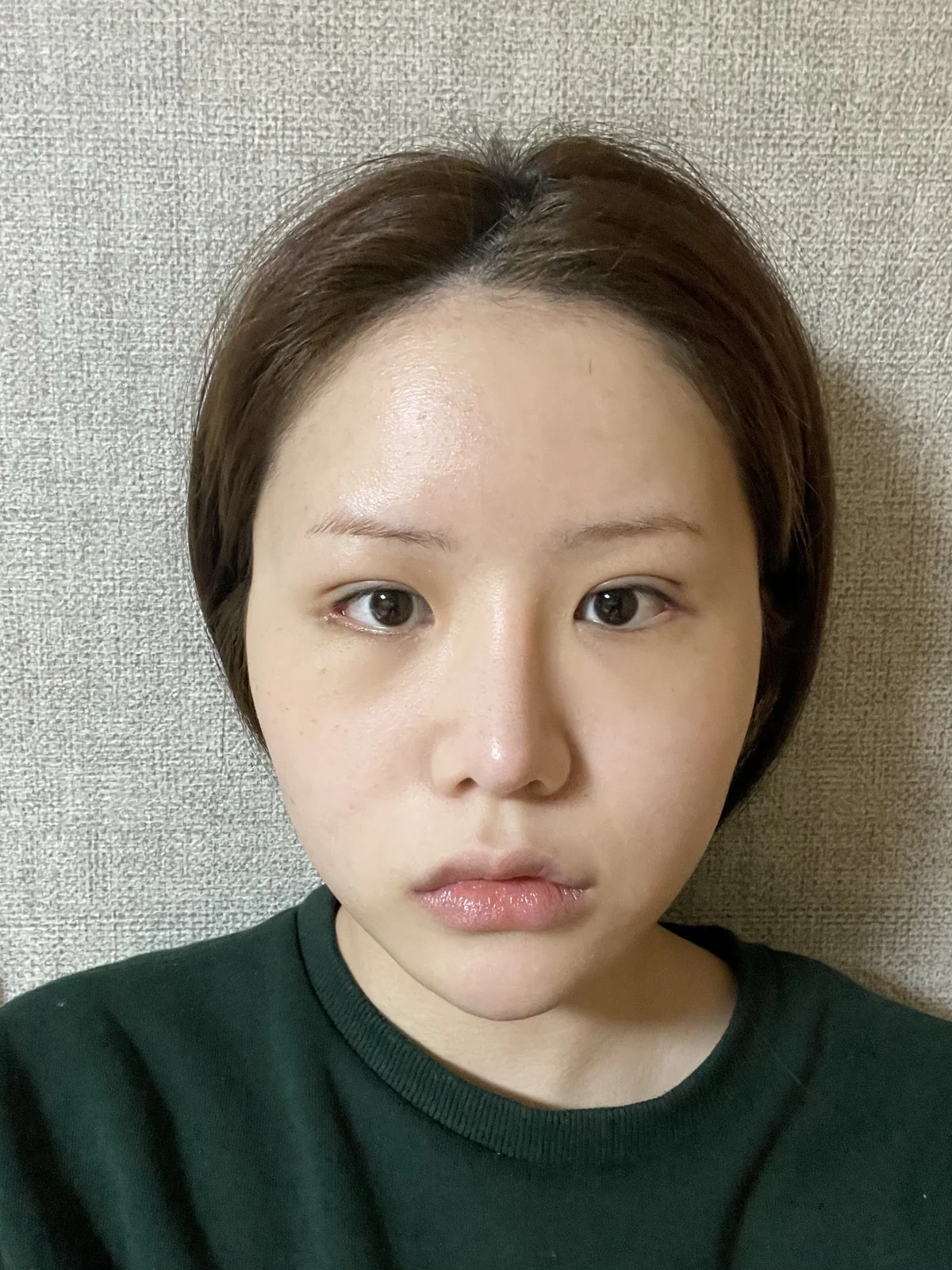 Ptosis correction and Wonder canthoplasty: recovery through two months · Case 051 at Answer Plastic Surgery. Front view, 2 weeks after ptosis correction and Wonder canthoplasty at Answer Plastic Surgery.