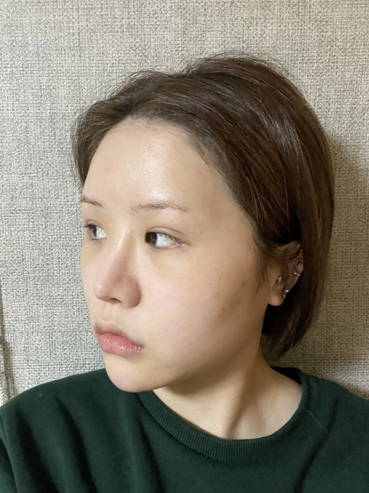 Ptosis correction and Wonder canthoplasty: recovery through two months · Case 051 at Answer Plastic Surgery. Angled view facing left, 2 weeks after ptosis correction and Wonder canthoplasty at Answer Plastic Surgery.