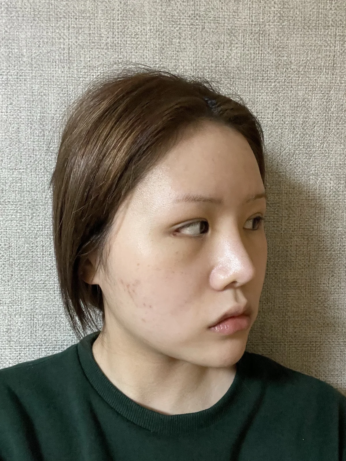 Ptosis correction and Wonder canthoplasty: recovery through two months · Case 051 at Answer Plastic Surgery. Angled view facing right, 2 weeks after ptosis correction and Wonder canthoplasty at Answer Plastic Surgery.