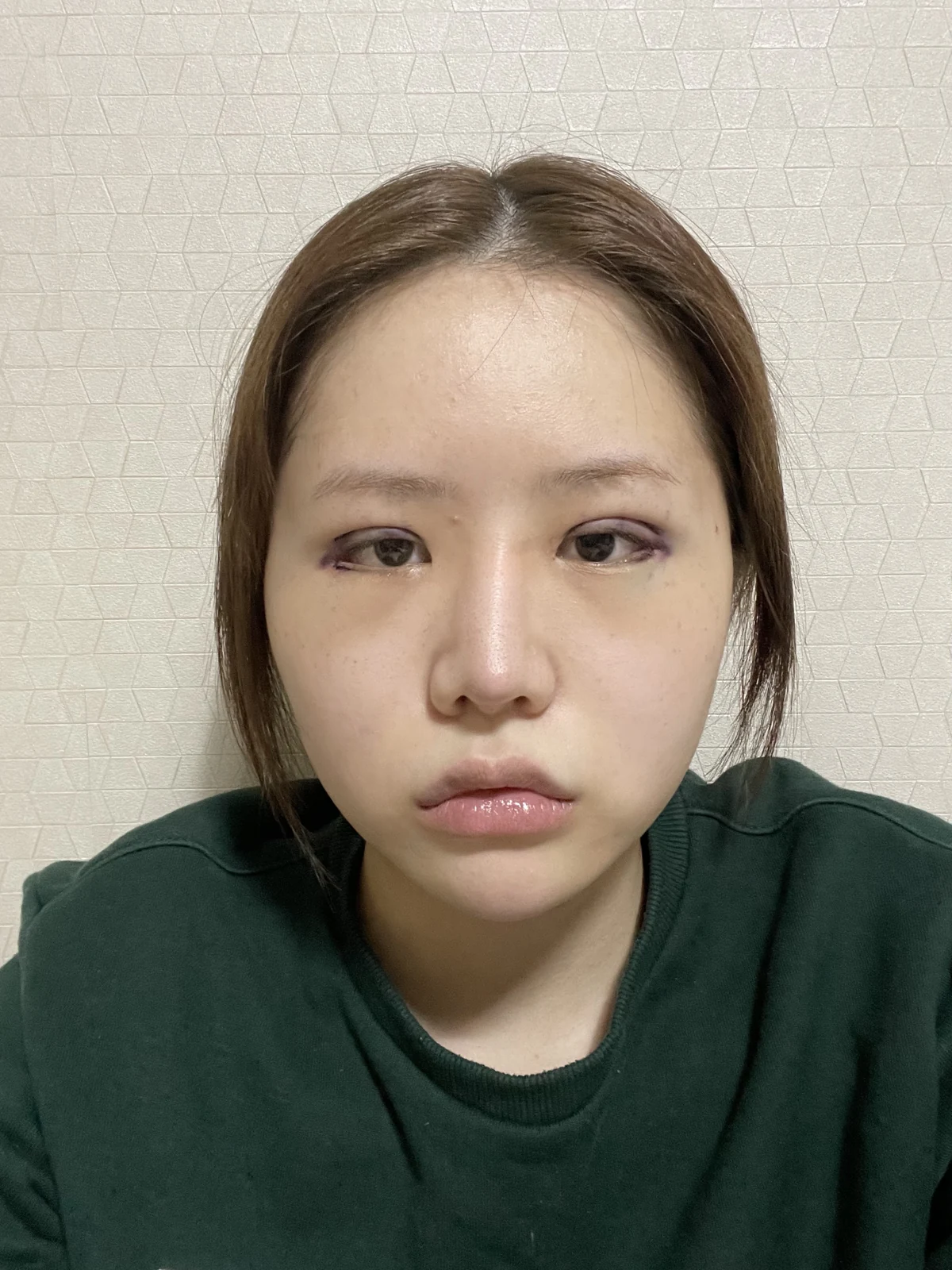 Ptosis correction and Wonder canthoplasty: recovery through two months · Case 051 at Answer Plastic Surgery. Front view, surgery day after ptosis correction and Wonder canthoplasty at Answer Plastic Surgery.