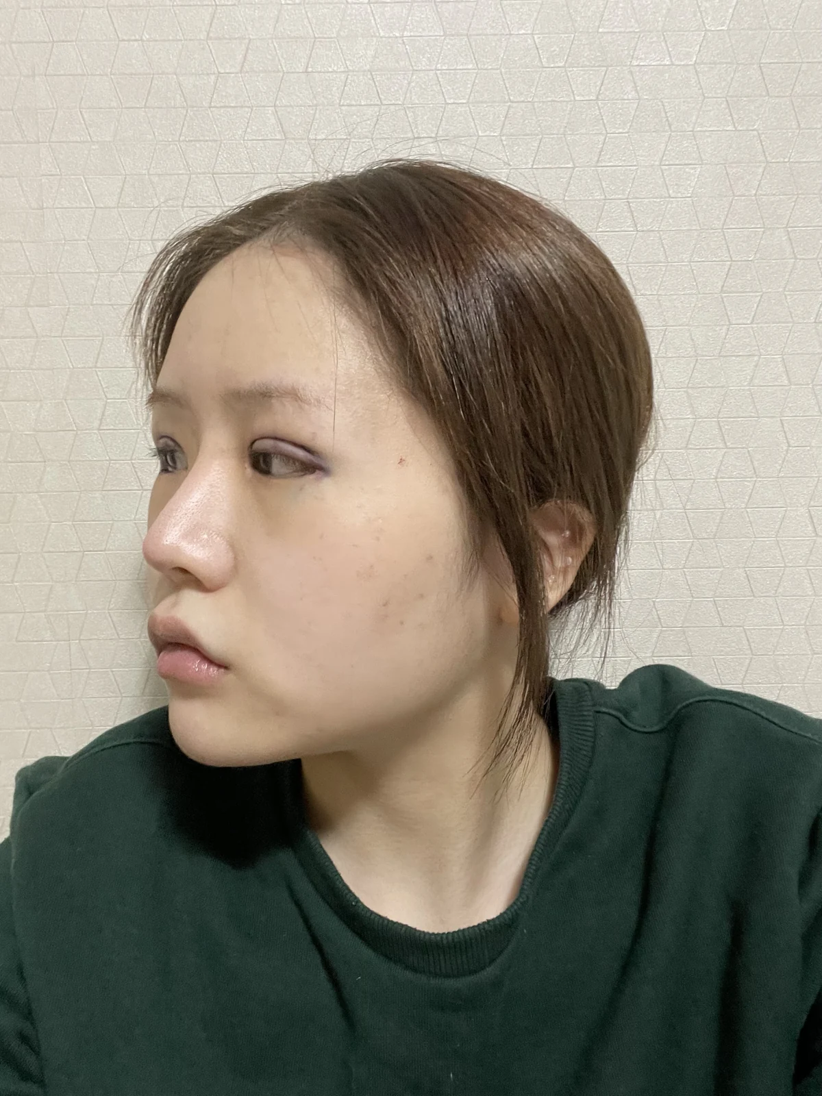 Ptosis correction and Wonder canthoplasty: recovery through two months · Case 051 at Answer Plastic Surgery. Angled view facing left, surgery day after ptosis correction and Wonder canthoplasty at Answer Plastic Surgery.