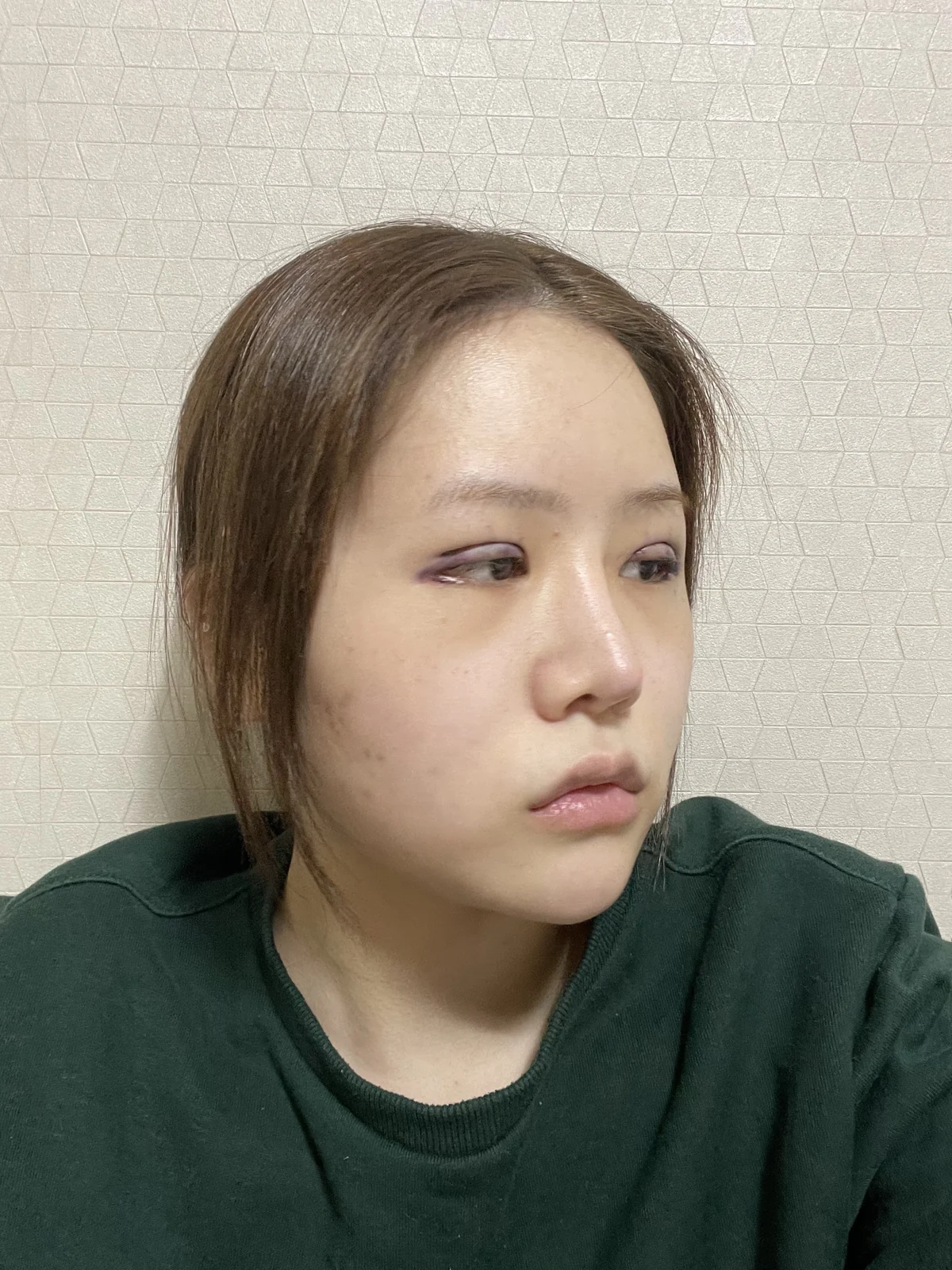 Ptosis correction and Wonder canthoplasty: recovery through two months · Case 051 at Answer Plastic Surgery. Angled view facing right, surgery day after ptosis correction and Wonder canthoplasty at Answer Plastic Surgery.