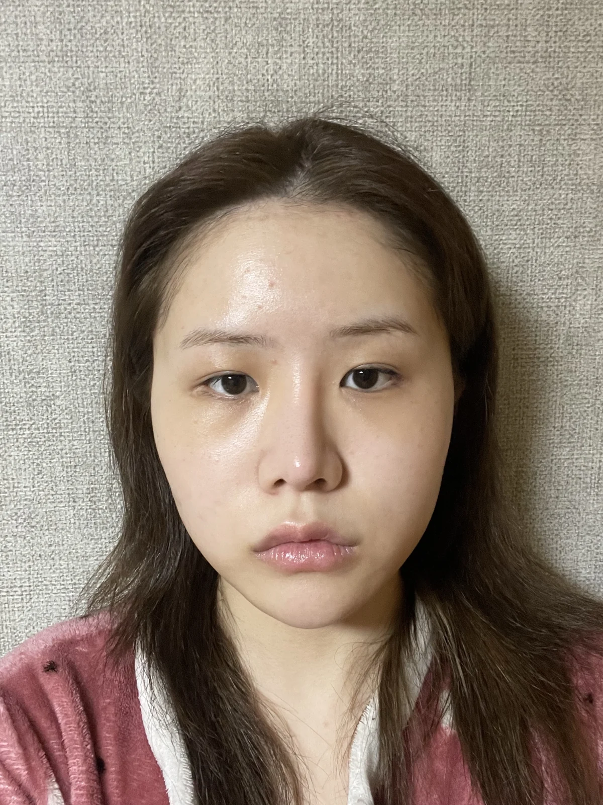 Ptosis correction and Wonder canthoplasty: recovery through two months · Case 051 at Answer Plastic Surgery. Front view before ptosis correction and Wonder canthoplasty at Answer Plastic Surgery.