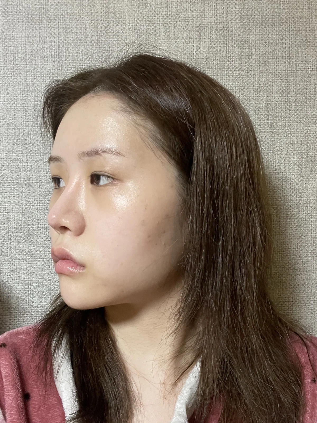Ptosis correction and Wonder canthoplasty: recovery through two months · Case 051 at Answer Plastic Surgery. Angled view facing left before ptosis correction and Wonder canthoplasty at Answer Plastic Surgery.
