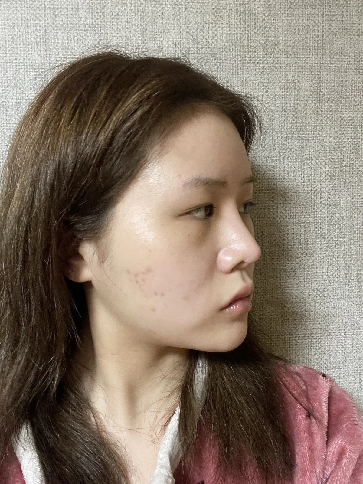 Ptosis correction and Wonder canthoplasty: recovery through two months · Case 051 at Answer Plastic Surgery. Angled view facing right before ptosis correction and Wonder canthoplasty at Answer Plastic Surgery.