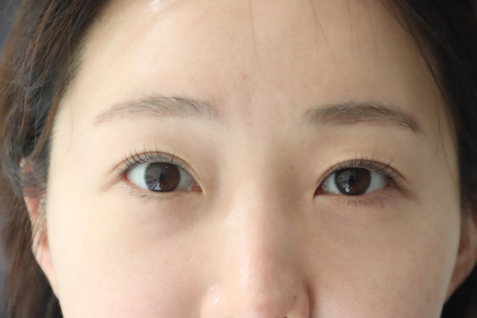 Lateral canthoplasty: recovery from surgery day to six months · Case 040 at Answer Plastic Surgery. Before: front close-up of the eye area before lateral canthoplasty at Answer Plastic Surgery, ANS-040.