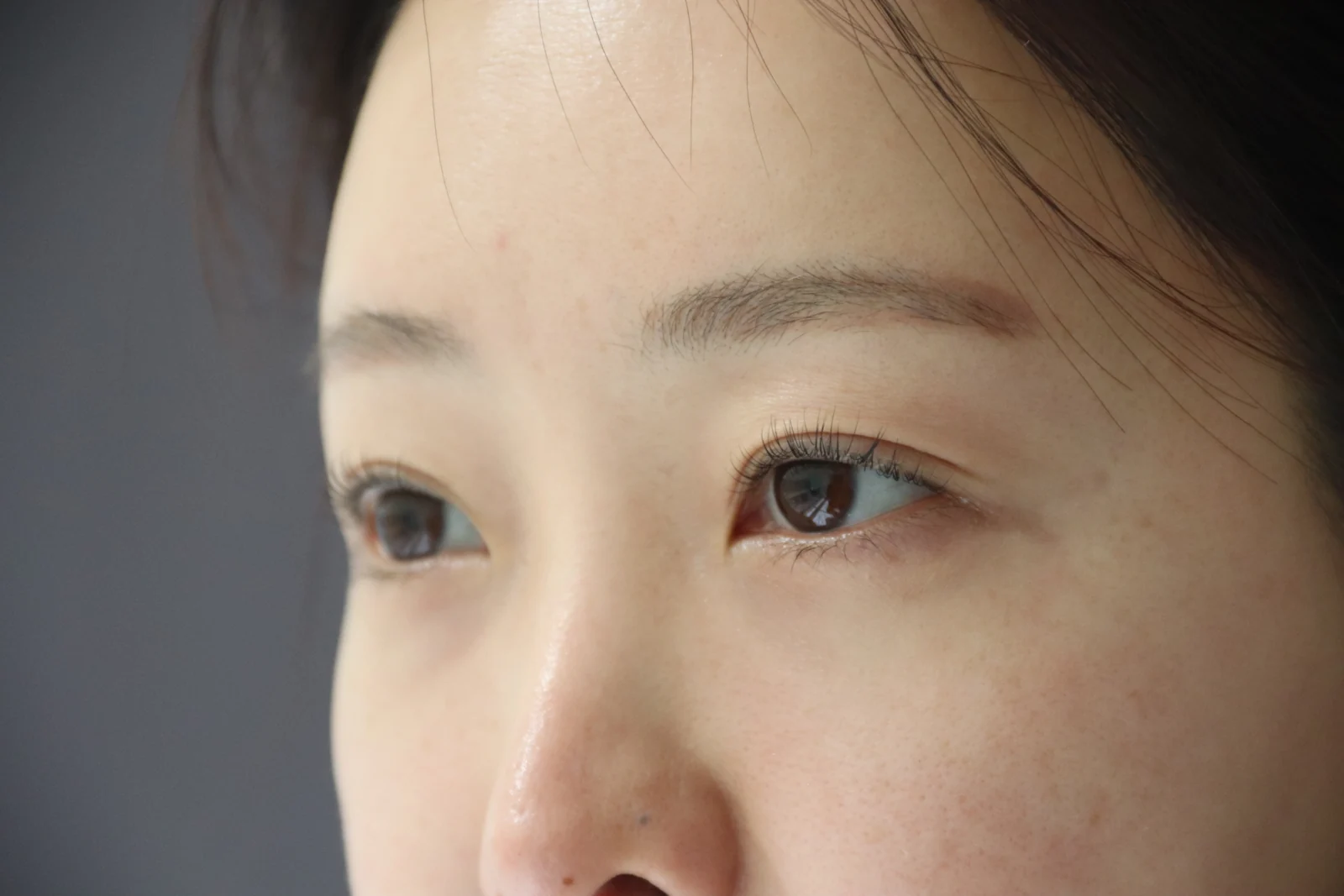 Lateral canthoplasty: recovery from surgery day to six months · Case 040 at Answer Plastic Surgery. Before: angled close-up of the eye area before lateral canthoplasty at Answer Plastic Surgery, ANS-040.