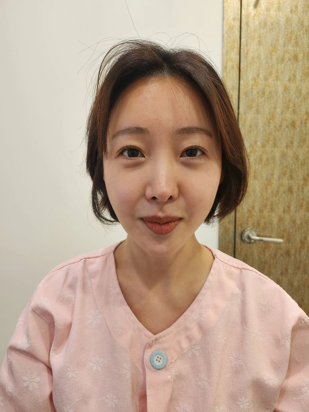 Lateral canthoplasty: recovery from surgery day to six months · Case 040 at Answer Plastic Surgery. Before: front view of the eye area before lateral canthoplasty at Answer Plastic Surgery, ANS-040.