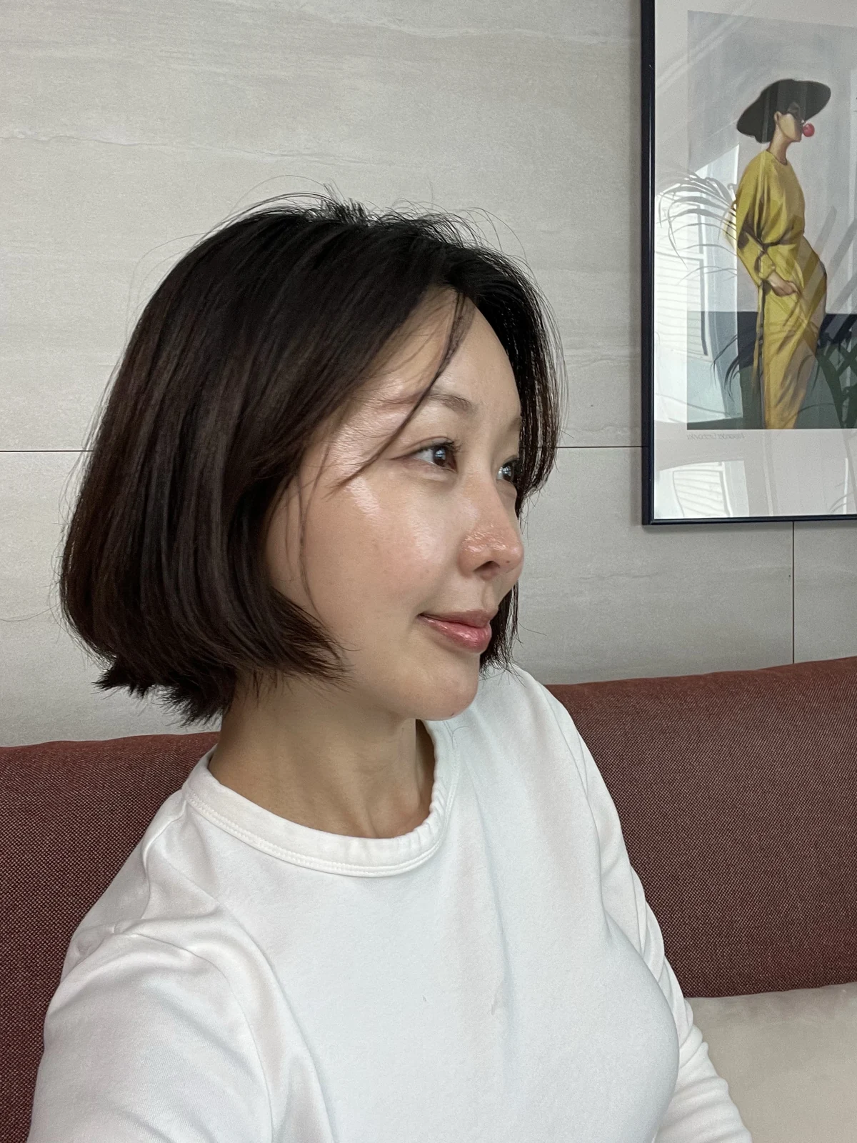 Lateral canthoplasty: recovery from surgery day to six months · Case 040 at Answer Plastic Surgery. One month: angled view of the eye area following the clinic’s case sequence for lateral canthoplasty, ANS-040.