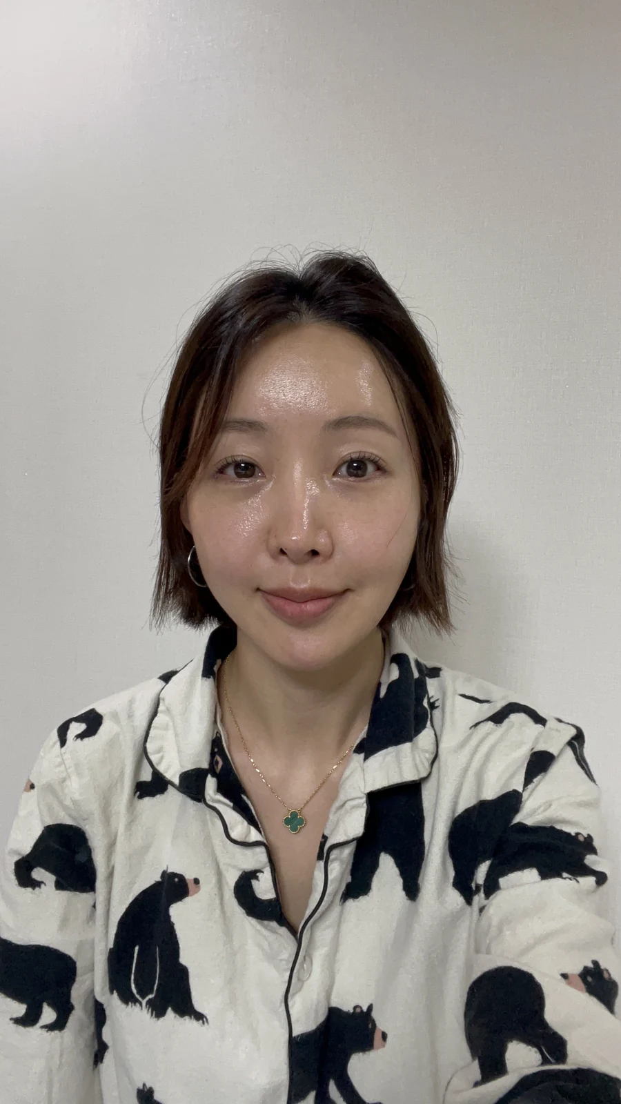 Lateral canthoplasty: recovery from surgery day to six months · Case 040 at Answer Plastic Surgery. One week, before suture removal: front view of the eye area following the clinic’s case sequence for lateral canthoplasty, ANS-040.