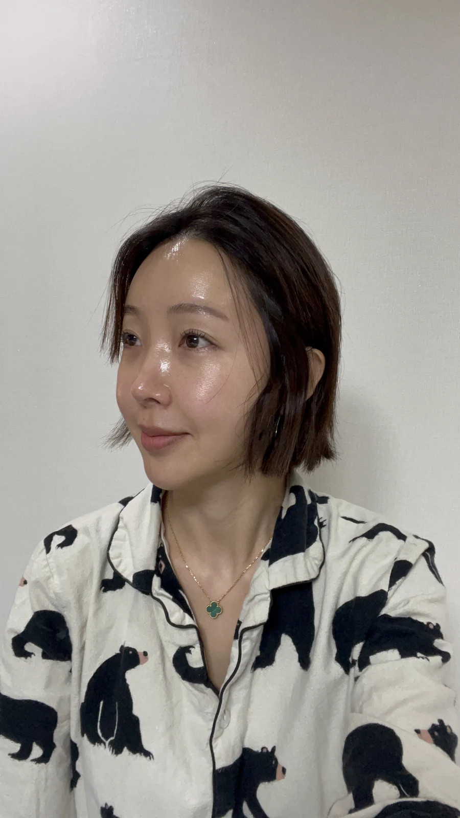 Lateral canthoplasty: recovery from surgery day to six months · Case 040 at Answer Plastic Surgery. One week, before suture removal: angled view of the eye area following the clinic’s case sequence for lateral canthoplasty, ANS-040.