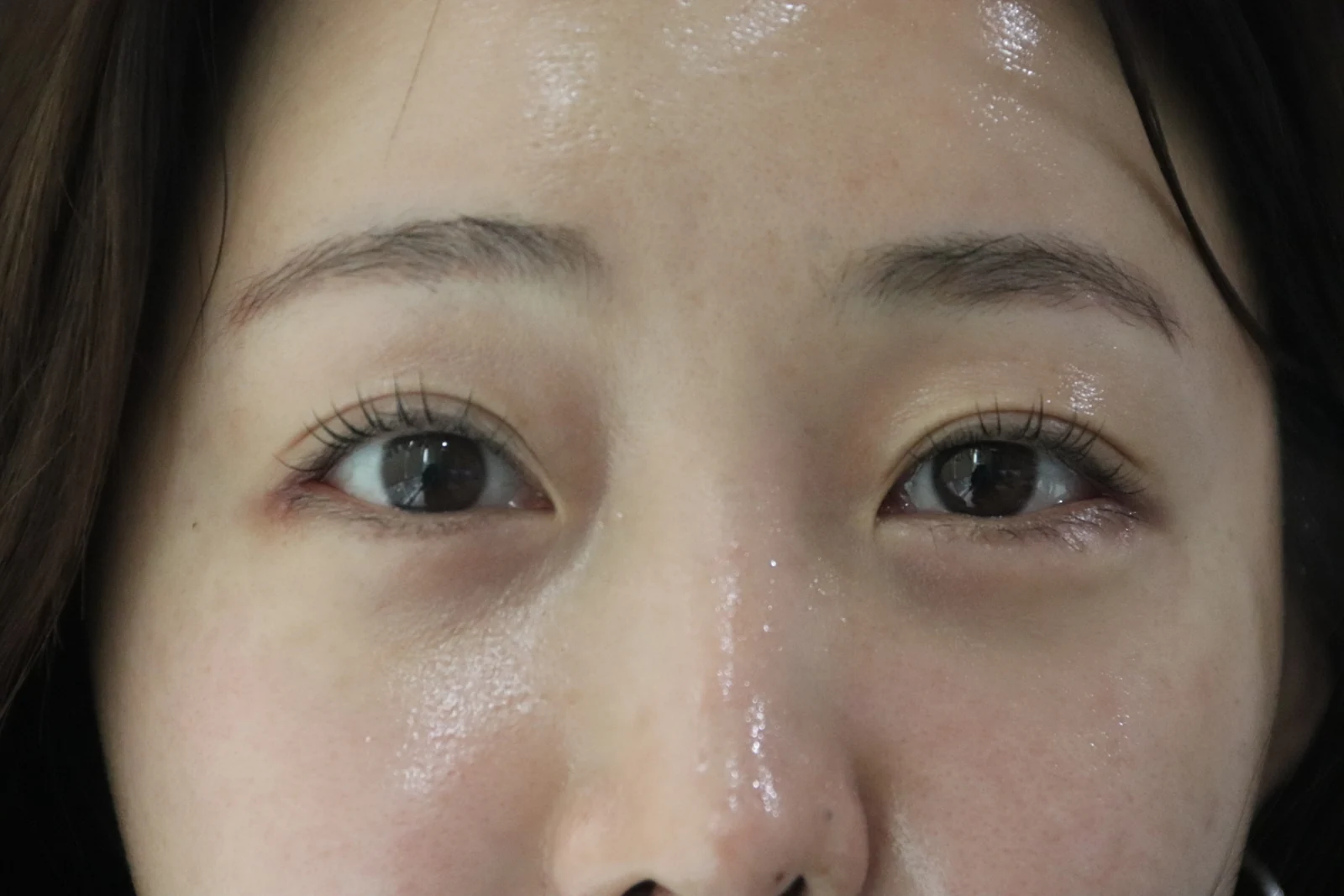 Lateral canthoplasty: recovery from surgery day to six months · Case 040 at Answer Plastic Surgery. One week, after suture removal: front close-up of the eye area following the clinic’s case sequence for lateral canthoplasty, ANS-040.